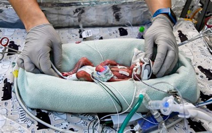 Do 25 week babies survive?