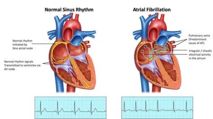 Do and don'ts after heart ablation?