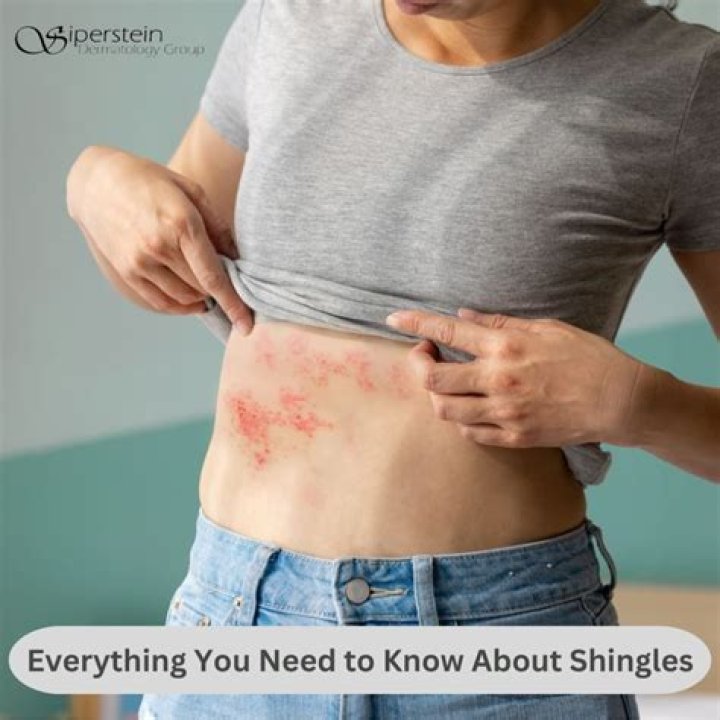 Do shingles make you tired?