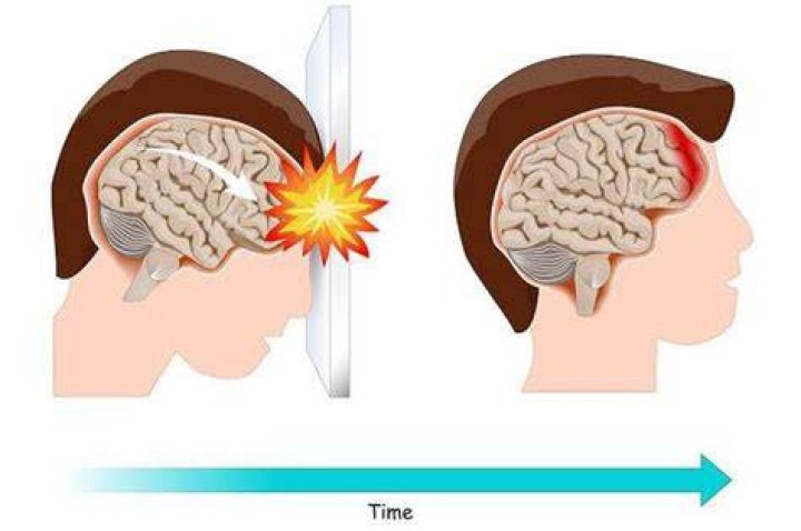 Does shaking your head damage your brain?
