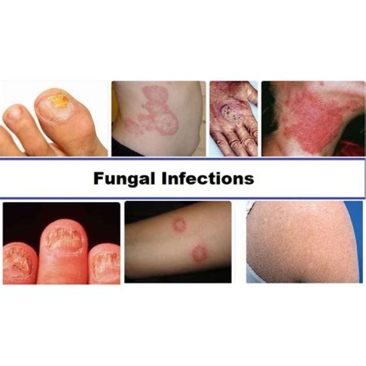 How do you treat fungal eczema?