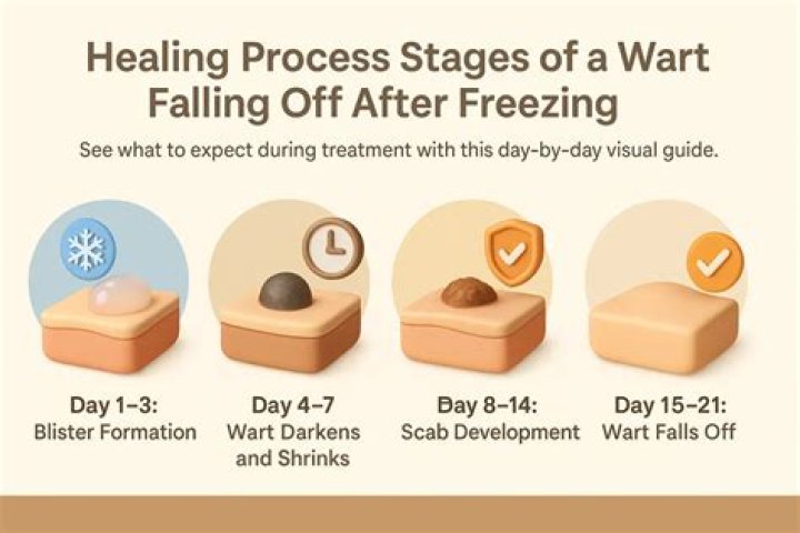 How does freezing a wart work?