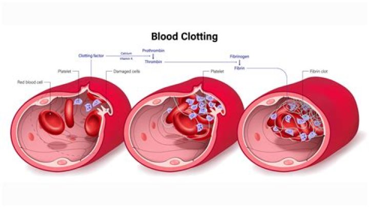 Is bed rest good for blood clots?
