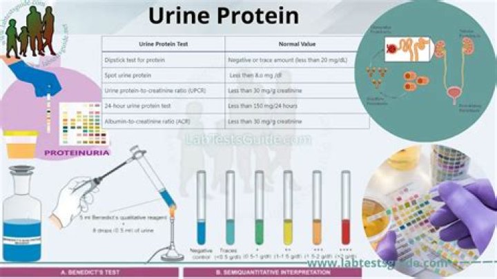 Is protein in urine serious?