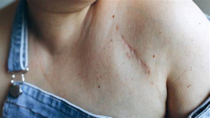What are the scars on Ari's arm from?