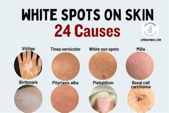 What are white spots on toes?