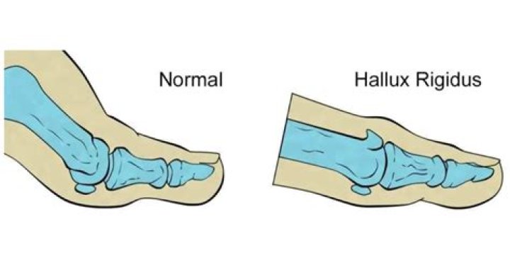What does hallux rigidus feel like?