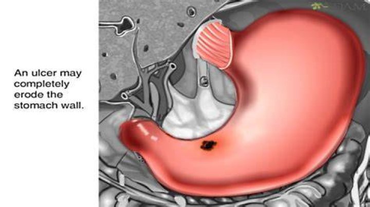 What happens if ulcer burst in stomach?