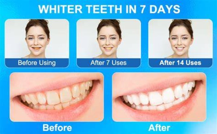 What is the most effective teeth whitening treatment?