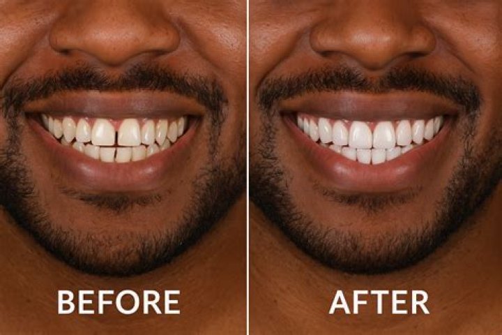 What toothpaste is good for veneers?