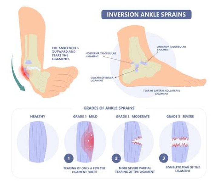 When does a sprain need surgery?