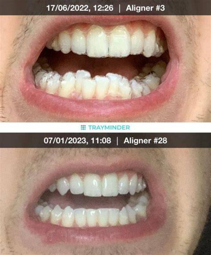 Why are my k9 teeth so pointy?
