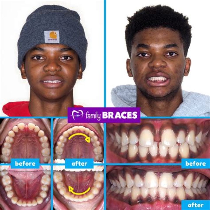 Why are my teeth slimy after braces?